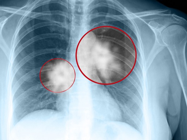 Chụp X-quang lồng ngực là một kĩ thuật để phát hiện ung thư phổi