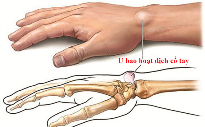 u bao hoạt dịch cổ tay