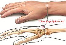 Phẫu thuật u nang bao hoạt dịch và những gì cần chuẩn bị u bao hoạt dịch cổ tay