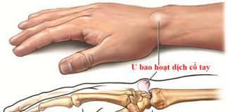 Phẫu thuật u nang bao hoạt dịch và những gì cần chuẩn bị u bao hoạt dịch cổ tay