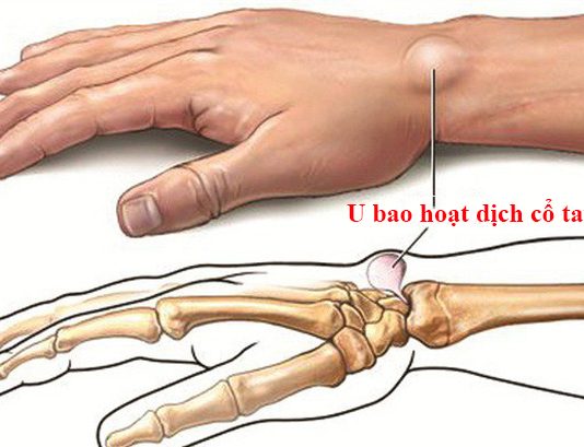 u bao hoạt dịch cổ tay